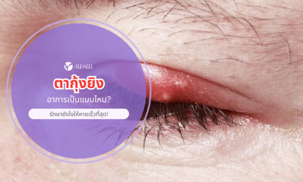 อาการตากุ้งยิง