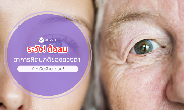 ระวัง! ต้อลม