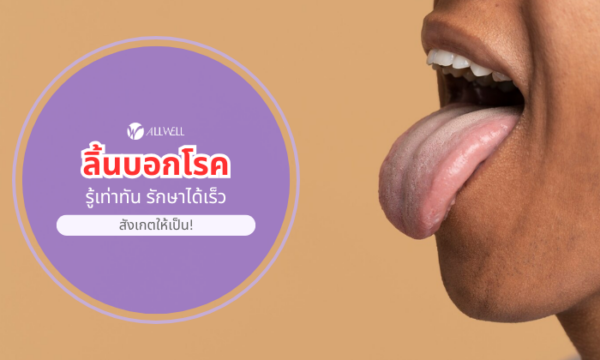 ลิ้นบอกโรค