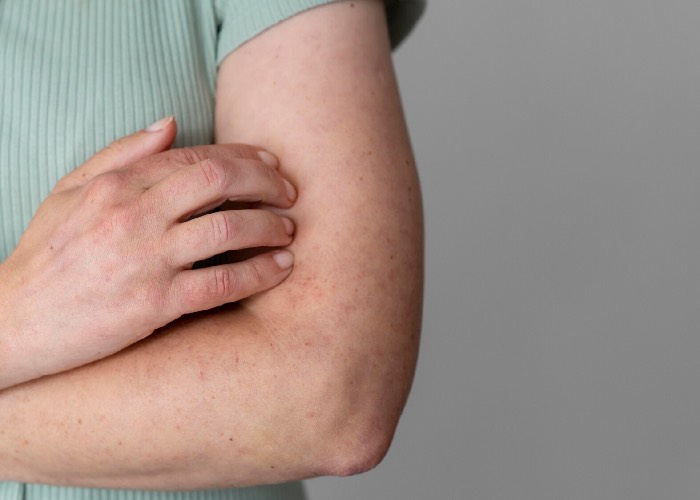 6 วิธีแก้ผื่นคัน - ผื่นขึ้นตามร่างกายให้อยู่หมัด!