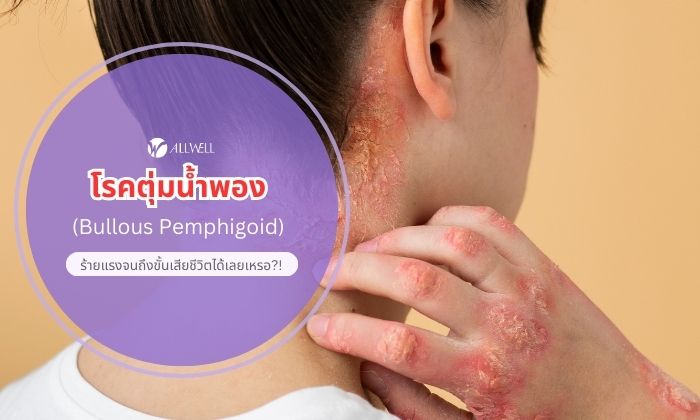 โรคตุ่มน้ำพอง เพมฟิกอยด์