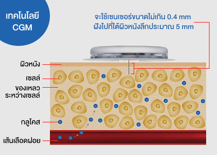 เครื่องตรวจเบาหวานไม่ต้องเจาะเลือด