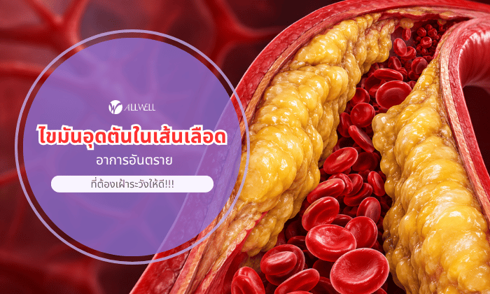ไขมันอุดตันในเส้นเลือด